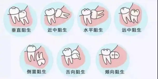 拔智齿