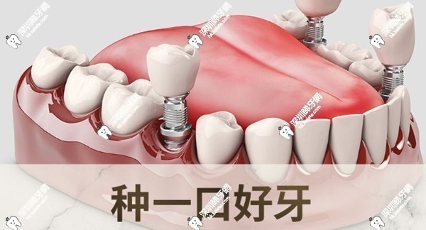 適合選擇易普萊種植體的人群