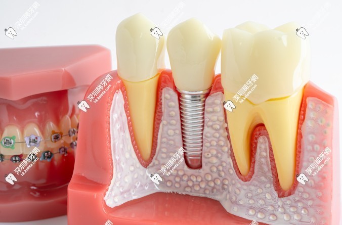 深圳人必看！2025愛康健口腔醫院價目表：種牙2980元起、矯正8800元起，11家分店真實收費公開