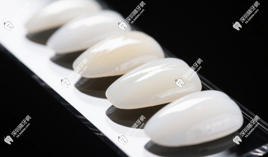 超薄牙齒貼面