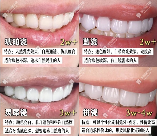 牙齒貼面能保持幾年？良心牙醫揭密牙貼面壽命及做牙齒貼面好不好？