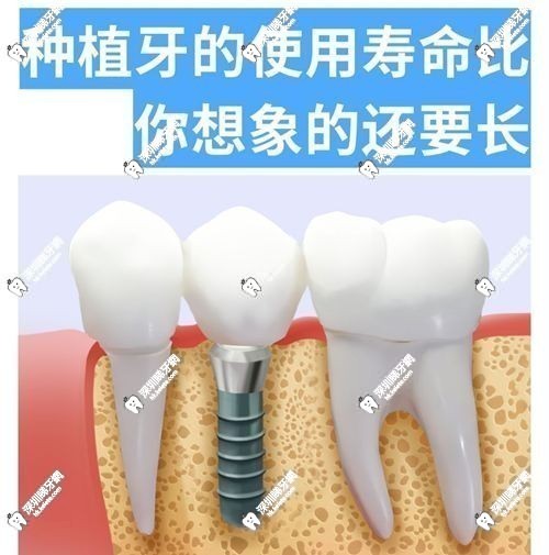 深圳杜小潤在哪裡坐診？坐診深圳富茂格倫菲爾口腔門診，擅長全口 / 半口種植技術（附預約）