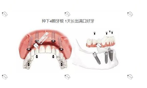 易普萊種植體的檔次定位
