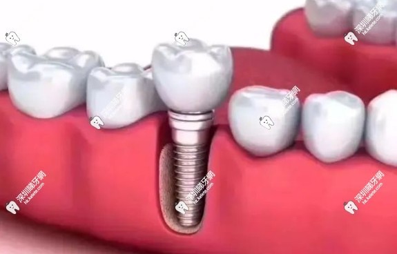 口腔种植