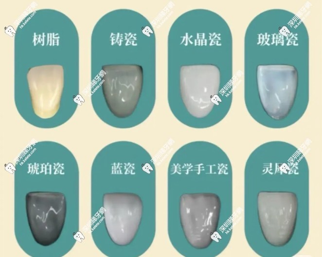 牙齒貼面能保持幾年？良心牙醫揭密牙貼面壽命及做牙齒貼面好不好？