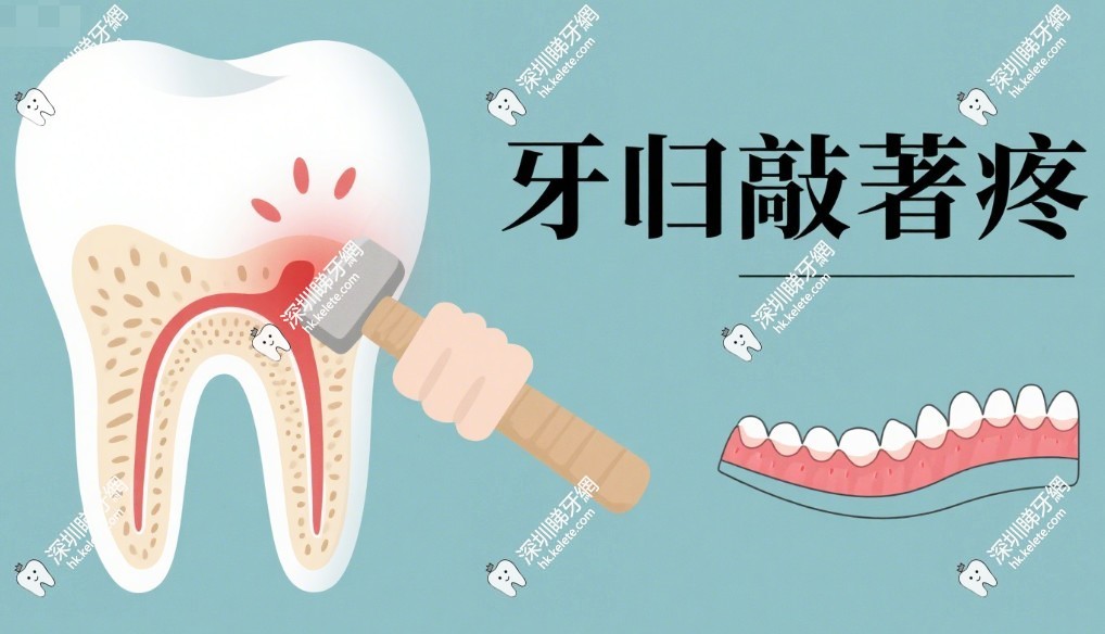 牙齒敲著痛就得做根管嗎？別慌！可能是牙齦發炎或牙隱裂，分情況處理更靠譜