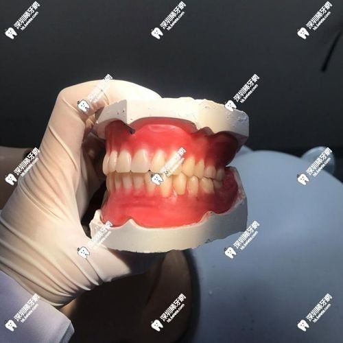 3D打印假牙你要知的真相