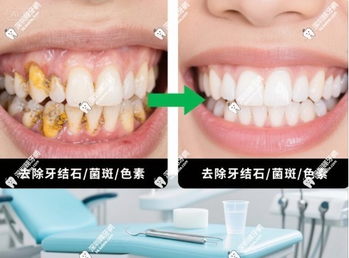 超聲波潔牙