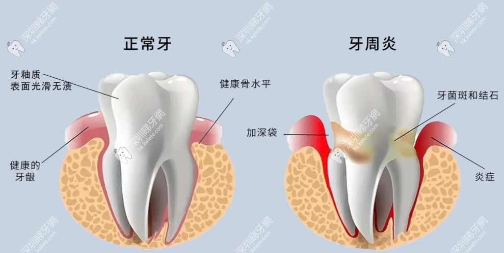 牙周治療的核心目的