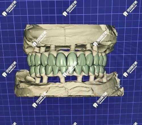 3D打印假牙比傳統假牙好
