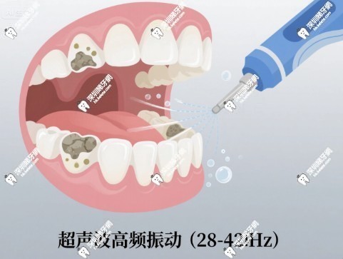 超聲波潔牙