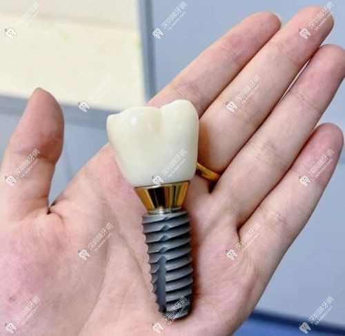 深圳10間機構種牙收費一覽 深圳10間機構種牙收費一覽
