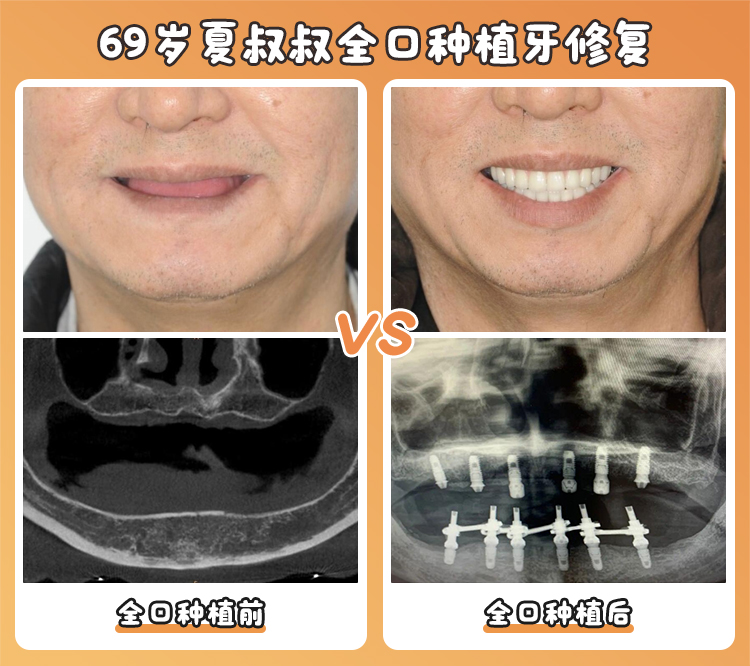二、格伦菲尔口腔种植牙價格差異原因：4大因素決定你要花多少錢