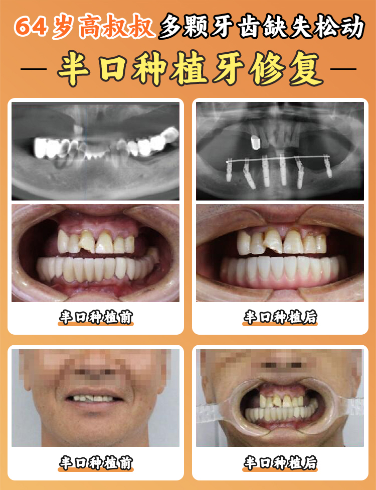 種植十顆牙的額外費用