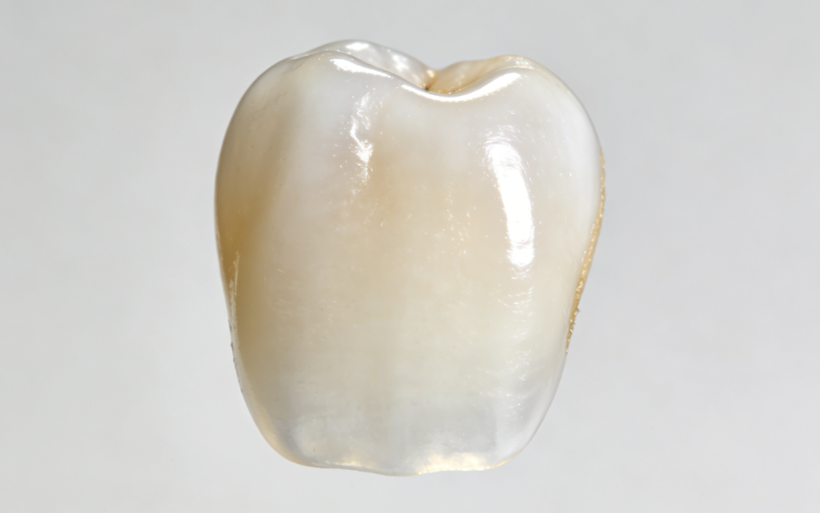 點樣揀選適合嘅牙齒貼面品牌