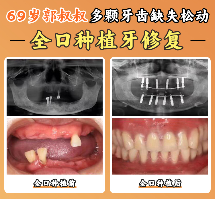 牙槽骨條件不好先面診