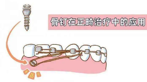 補牙